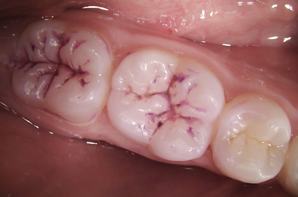Preventing decay with fissure sealants